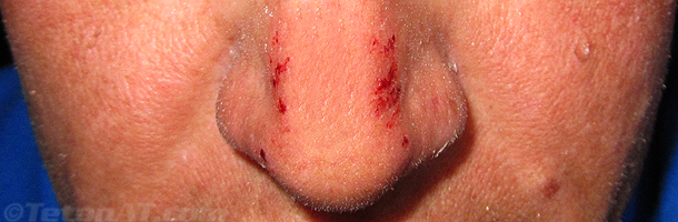 second degree sunburn